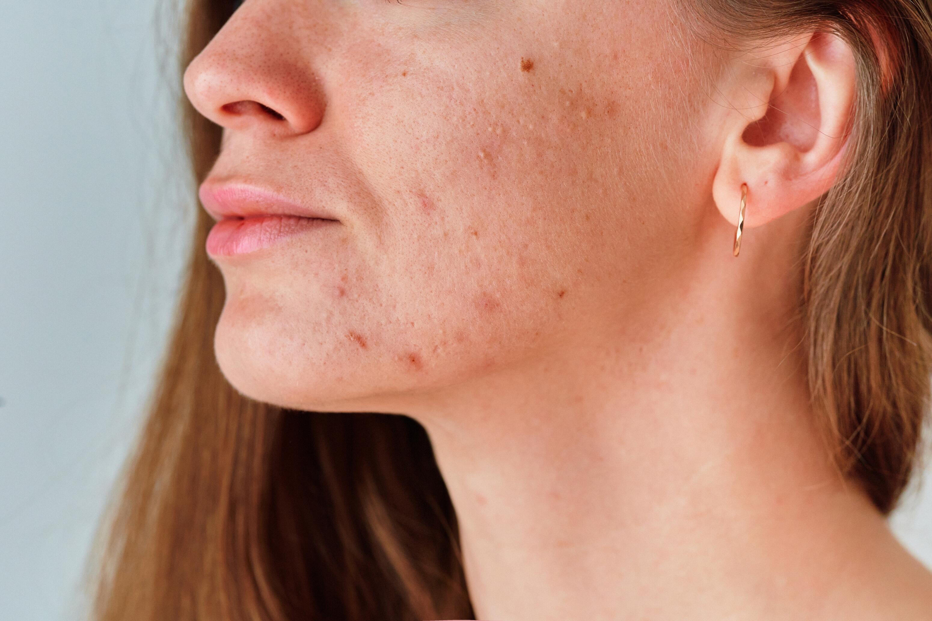 Inleiding tot acne bij volwassenen